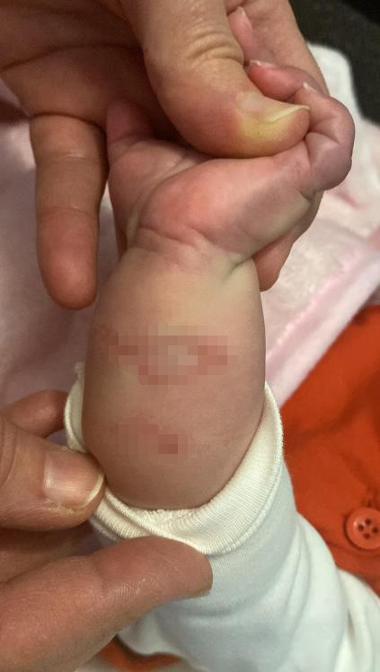 Hastanede doğan dördüz bebekler iddiaya göre kuvözde yandı, mikrop kaparak üçü öldü