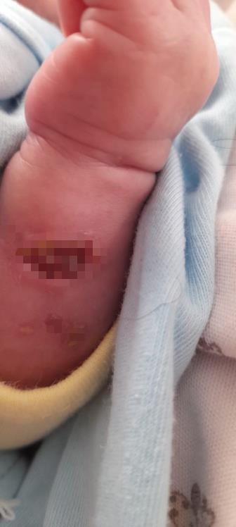 Hastanede doğan dördüz bebekler iddiaya göre kuvözde yandı, mikrop kaparak üçü öldü